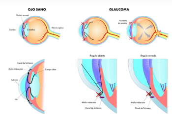 Glaucoma: el ladrón invisible de la visión