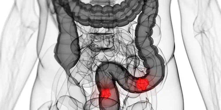 El Conicet La Plata busca desandar por completo el camino del cáncer colorrectal y sacarle a la enfermedad unas cuantas vidas de ventaja (crédito imagen: El Español)